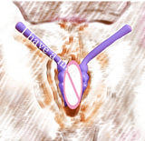  Pussy Expander Labia Spreader 